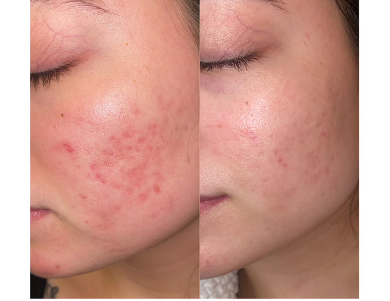Microneedling