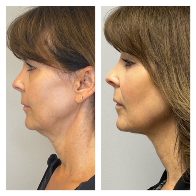 RF-Microneedling-Morpheus